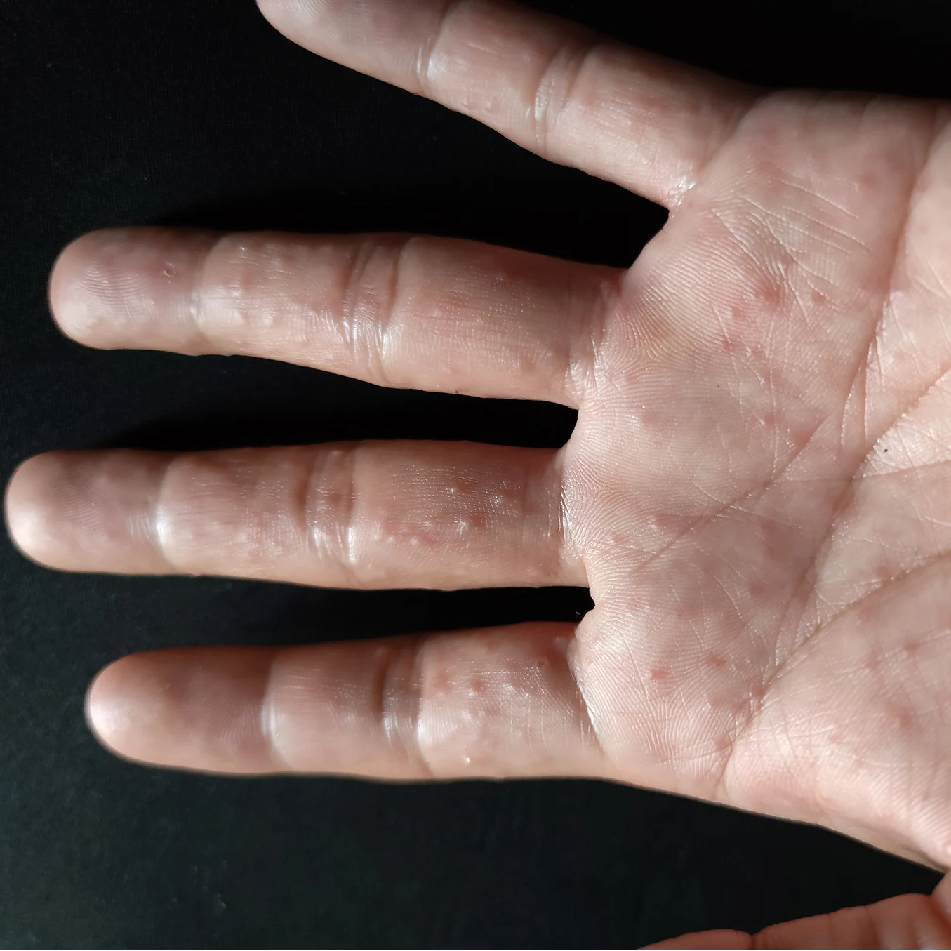 Allergy & Inflammation